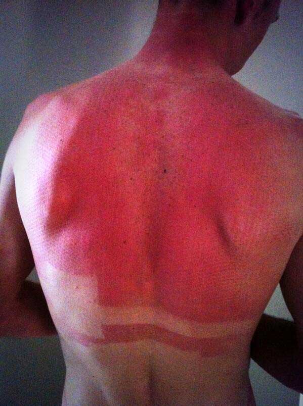 froome-sunburn.jpg