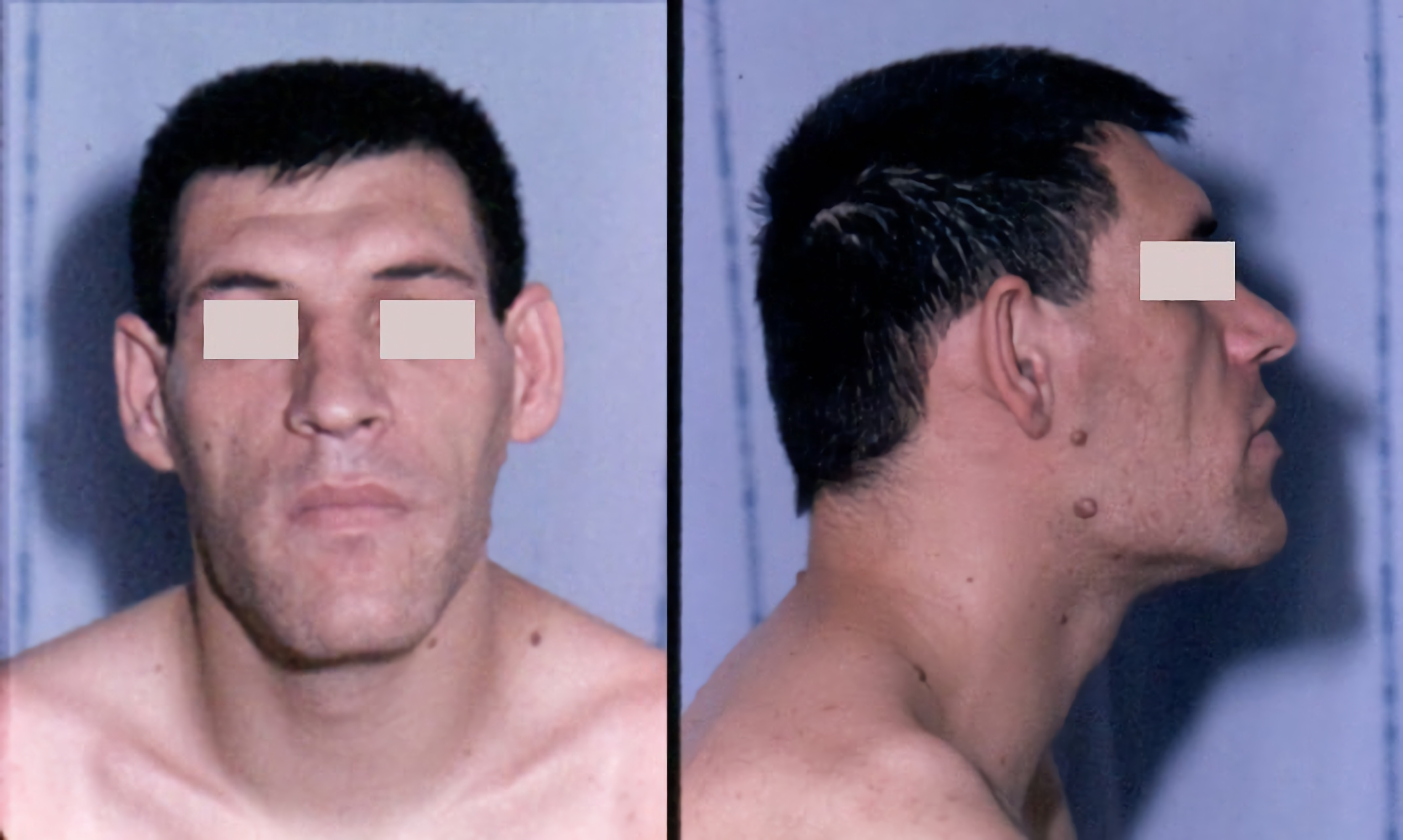 Acromegaly_facial_features.JPEG