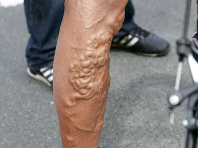 george-hincapie-leg-picture.jpg